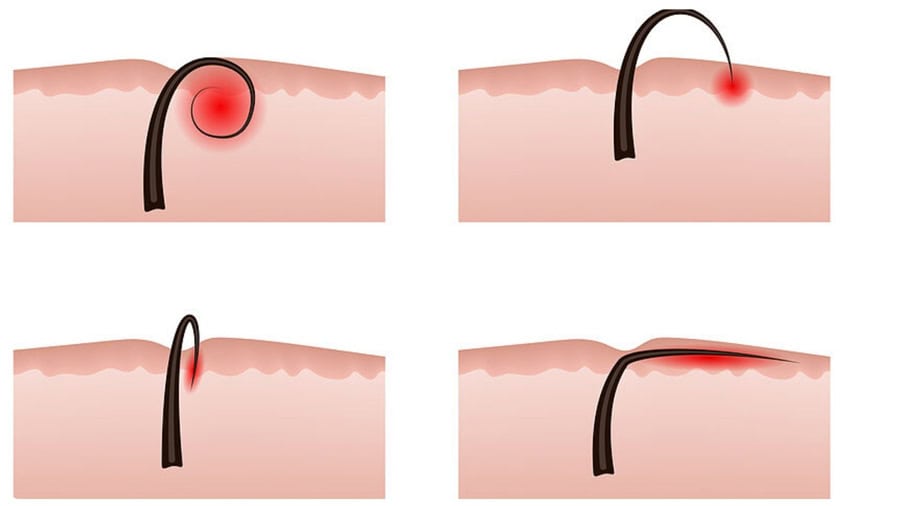 Nhổ lông nách có thể khiến lông mọc ngược gây viêm da