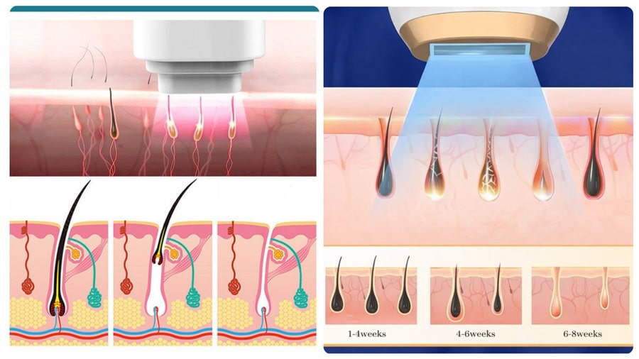 Công nghệ triệt lông hiện đại tác động sâu vào nang lông, giúp lông mọc thưa dần