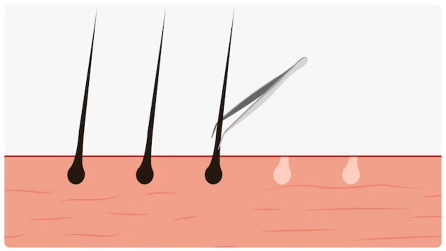 Nhổ lông nách sai cách có thể khiến da thâm và viêm
