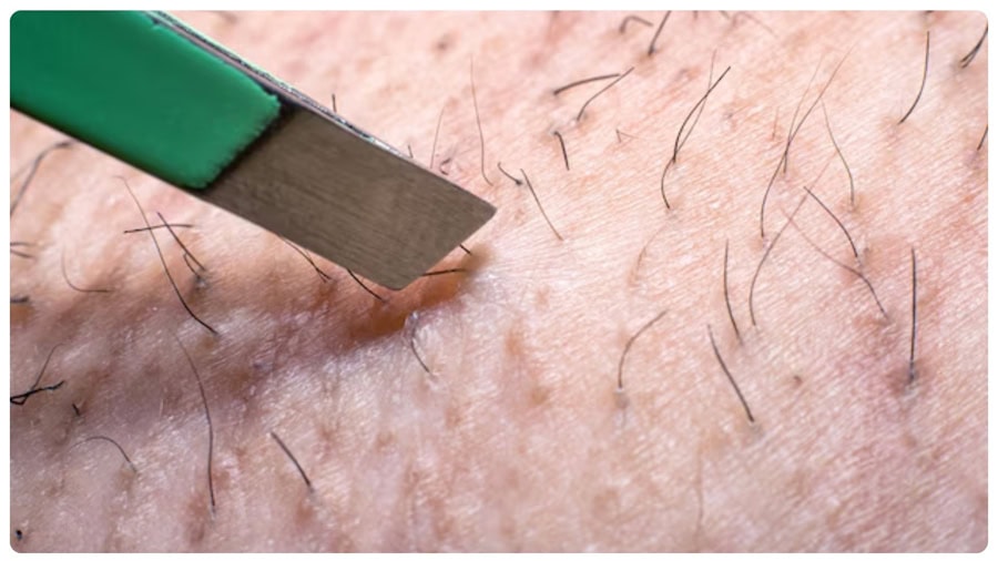 Nhổ lông nách không đúng cách dễ gây viêm nang lông và mùi khó chịu