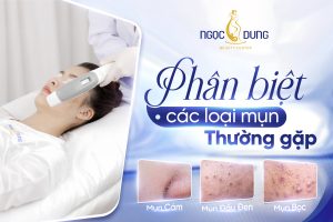 phân biệt các loại mụn thường gặp