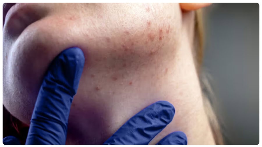 Da dễ bị kích ứng nếu không chăm sóc cẩn thận