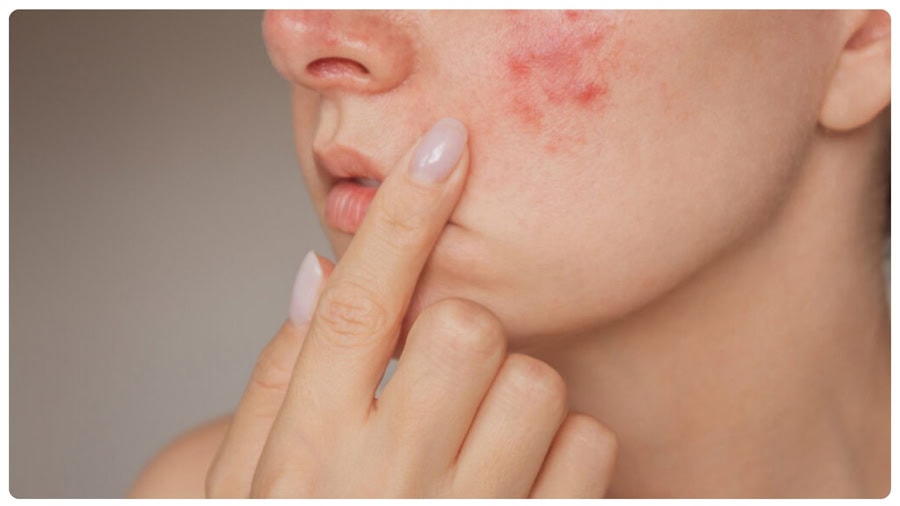 Da mụn viêm, mụn bọc không nên triệt lông mặt