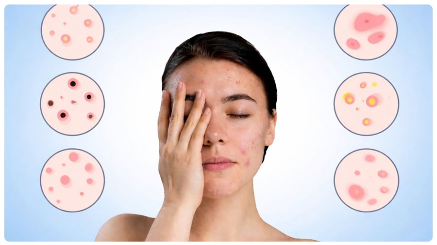 Sau triệt da nhạy cảm hơn nên dễ lên mụn nếu không chăm sóc đúng cách