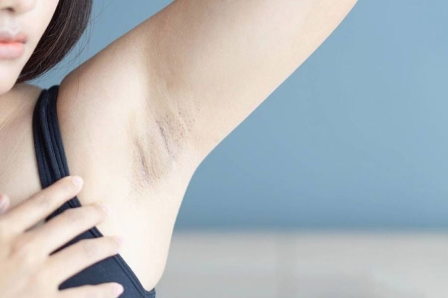 Thăm khám tình trạng trước khi triệt lông vĩnh viễn bằng Laser