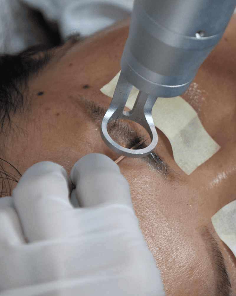 tien hanh xoa xam tham my