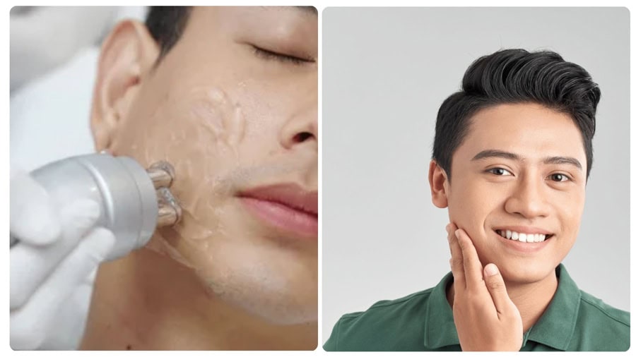 Có nên chọn triệt lông mặt giá rẻ?