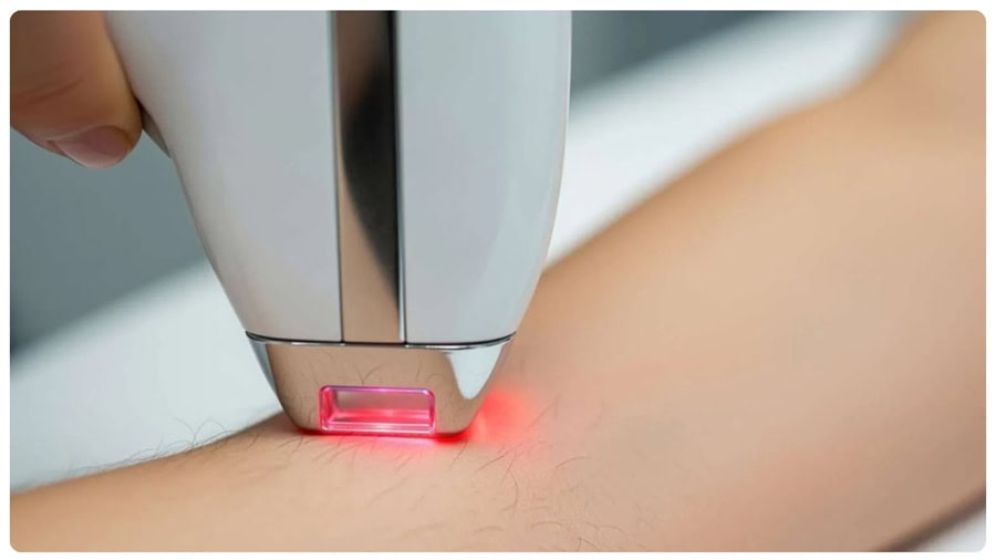 Triệt lông vĩnh viễn: Hiệu quả, rủi ro và cách chọn nơi uy tín 15 Sau khi triệt vĩnh viễn, lông bắt đầu mềm và thưa dần