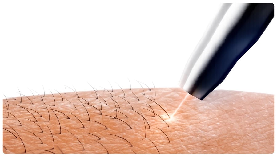 Triệt lông vĩnh viễn: Hiệu quả, rủi ro và cách chọn nơi uy tín 2 Triệt lông vĩnh viễn ngày càng được nhiều người lựa chọn