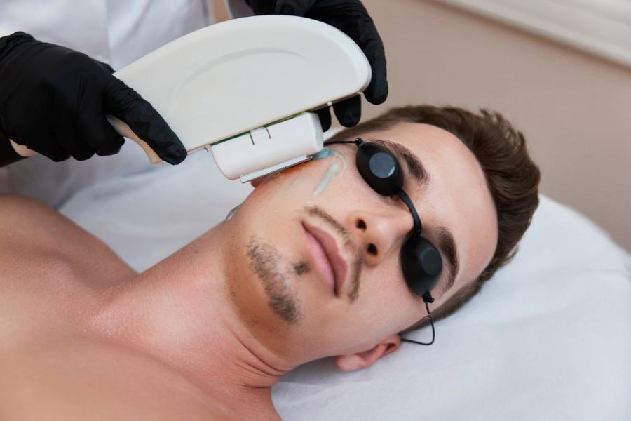 Triệt râu bằng laser: Liệu trình, so sánh và tiêu chí chọn spa
