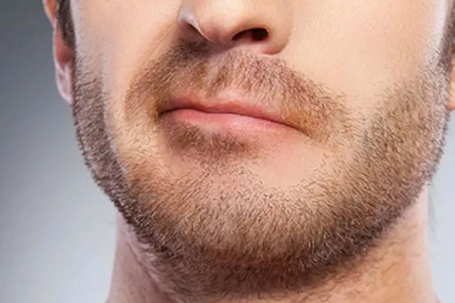Triệt râu bằng Laser phù hợp người có râu dày