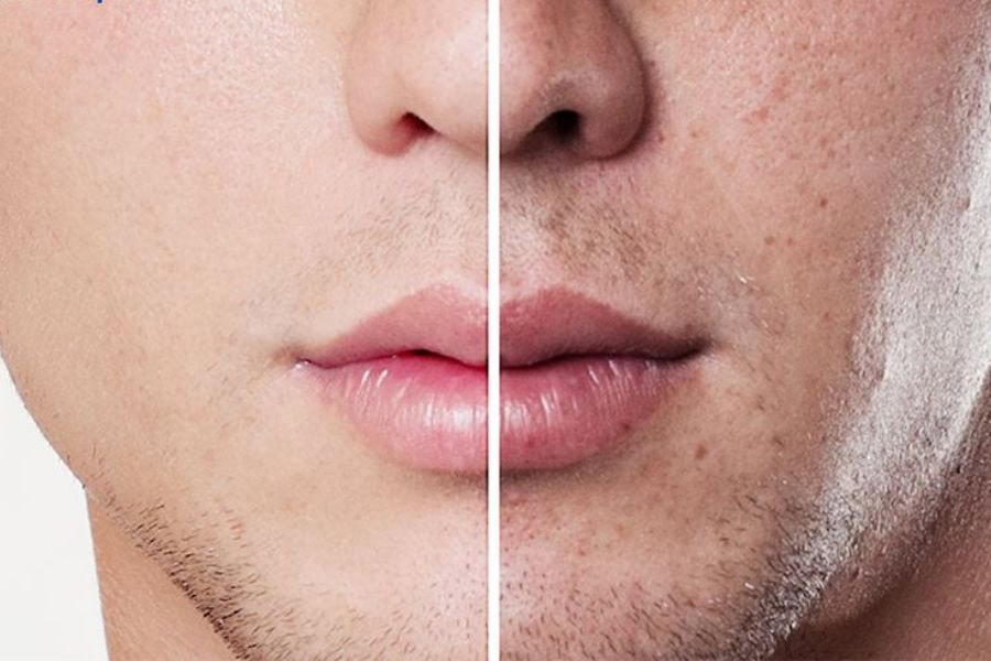 Triệt râu bằng Laser không còn là lựa chọn xa lạ