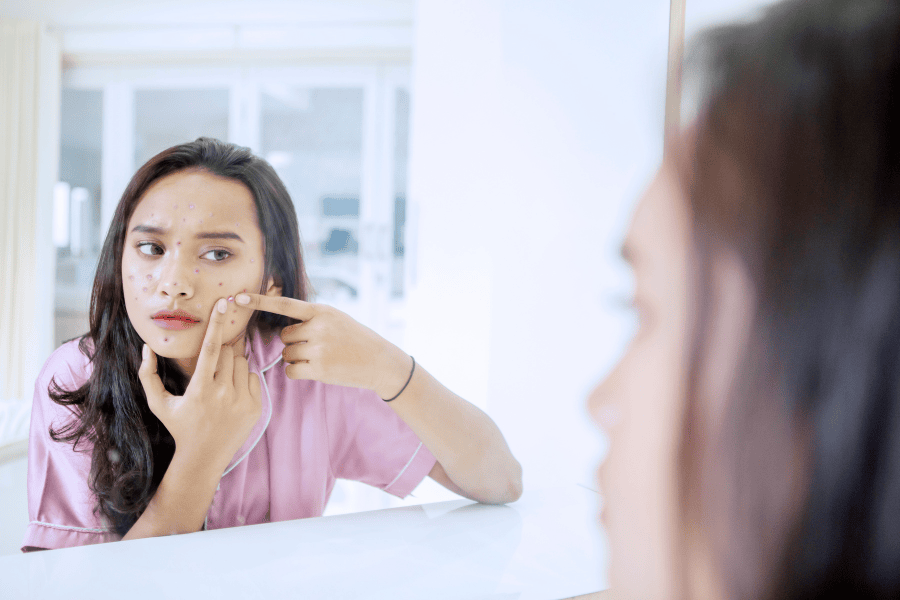 15+ Cách trị vết thâm mụn ở mặt đáng thử nhất 5 Tự nặn mụn khiến da bị thâm lâu hơn