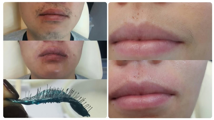 Wax râu có hại không? Giải đáp thắc mắc và lưu ý quan trọng 4 Nếu wax râu không đúng cách dễ gây kích ứng và đỏ rát