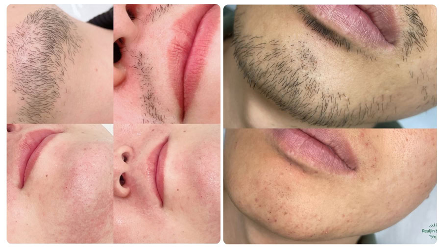 Wax râu có hại không? Giải đáp thắc mắc và lưu ý quan trọng 3 Wax râu giúp loại bỏ râu nhanh, mang lại làn da gọn gàng ngay sau khi thực hiện