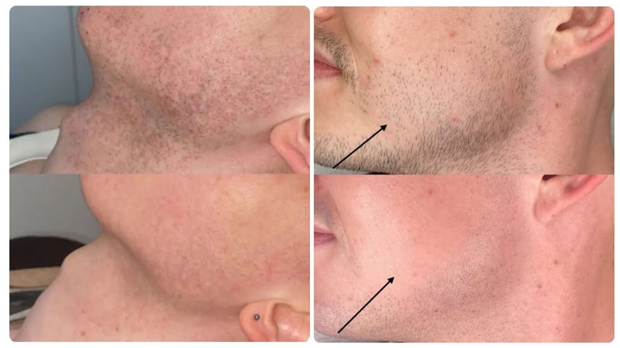 Wax râu có hại không? Giải đáp thắc mắc và lưu ý quan trọng 9 Triệt râu bằng công nghệ cao giúp râu mọc chậm, thưa và mềm hơn