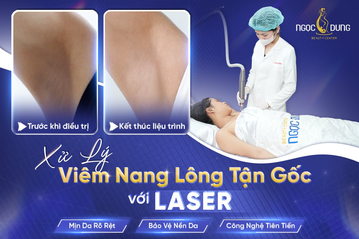 Điều trị viêm nang lông tận gốc và ngăn ngừa tái phát