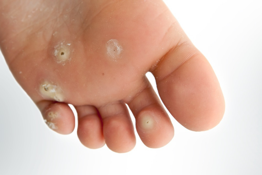 Bàn tay và bàn chân thường là vị trí bị nổi mụn cóc phổ biến