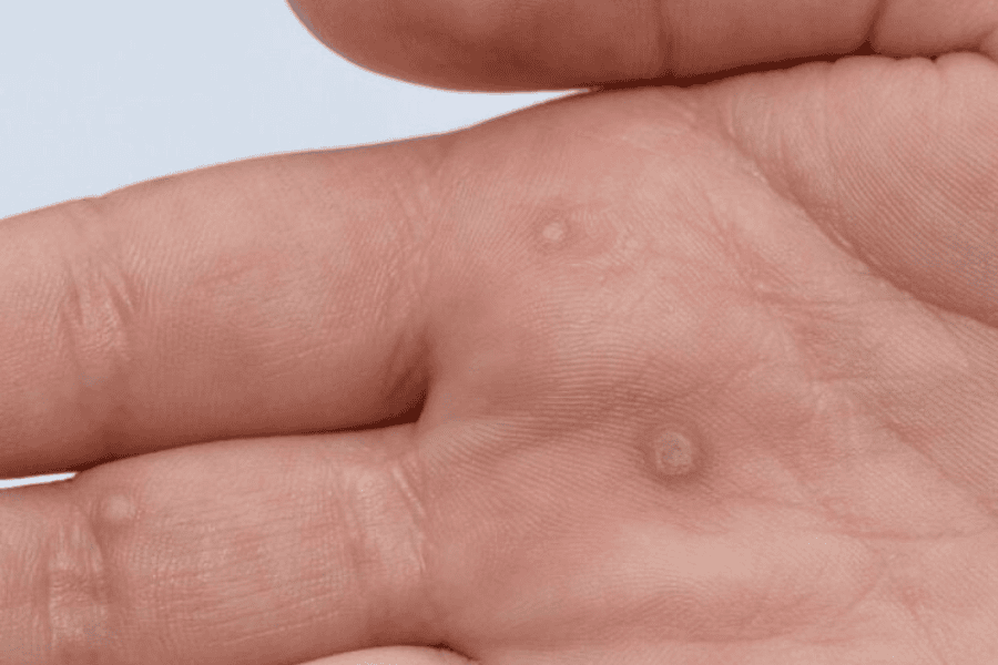 Mụn cóc thông thường không ảnh hưởng đến sức khỏe