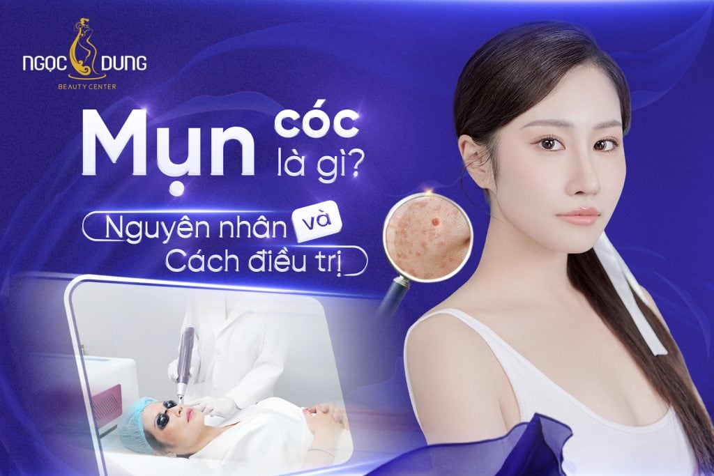 Mụn cóc là gì