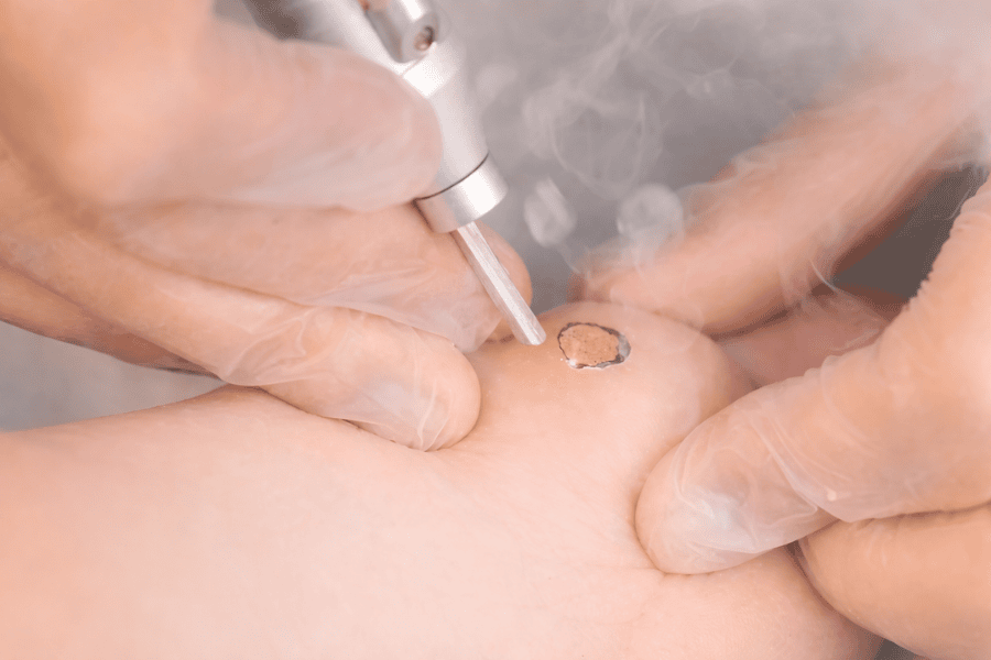 Cần thăm khám tình trạng mụn cóc với bác sĩ chuyên môn có quyết định chọn hướng đốt điện hay laser cho phù hợp