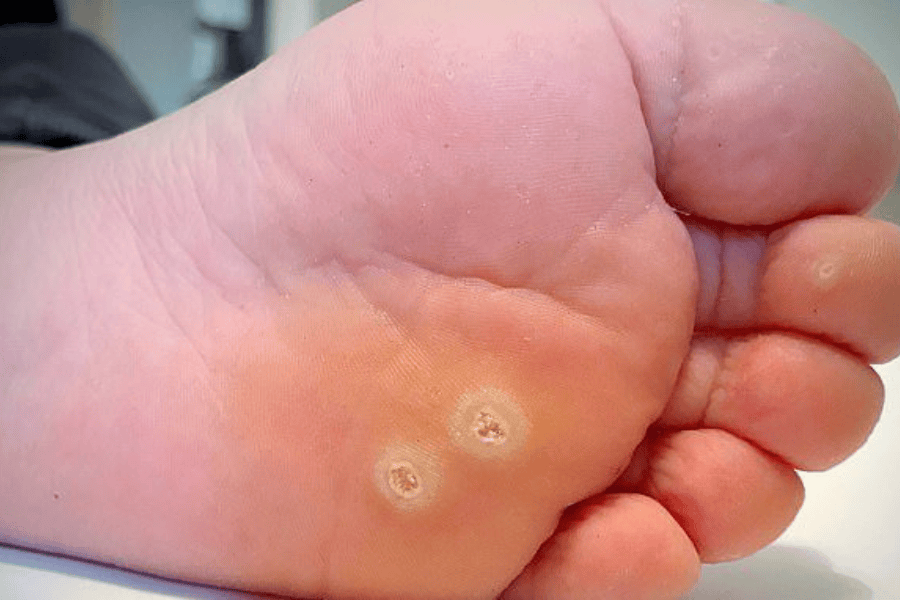 Ở mụn cóc da thông thường, nguy cơ chuyển thành ung thư rất hiếm