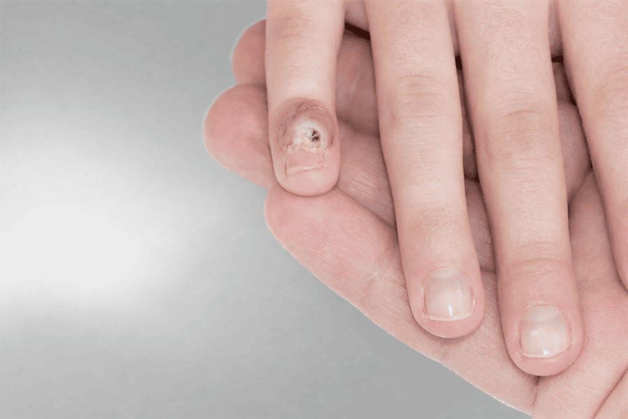 Mụn cóc kháng trị cần được xử lý bằng các giải pháp chuyên sâu