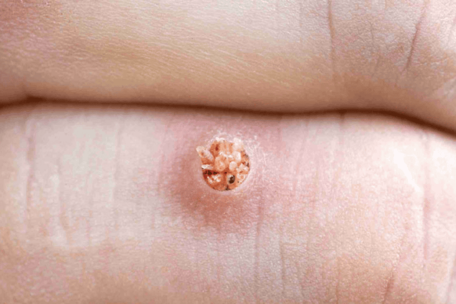 Mụn cóc có thể tái phát nếu miễn dịch của cơ thể kém