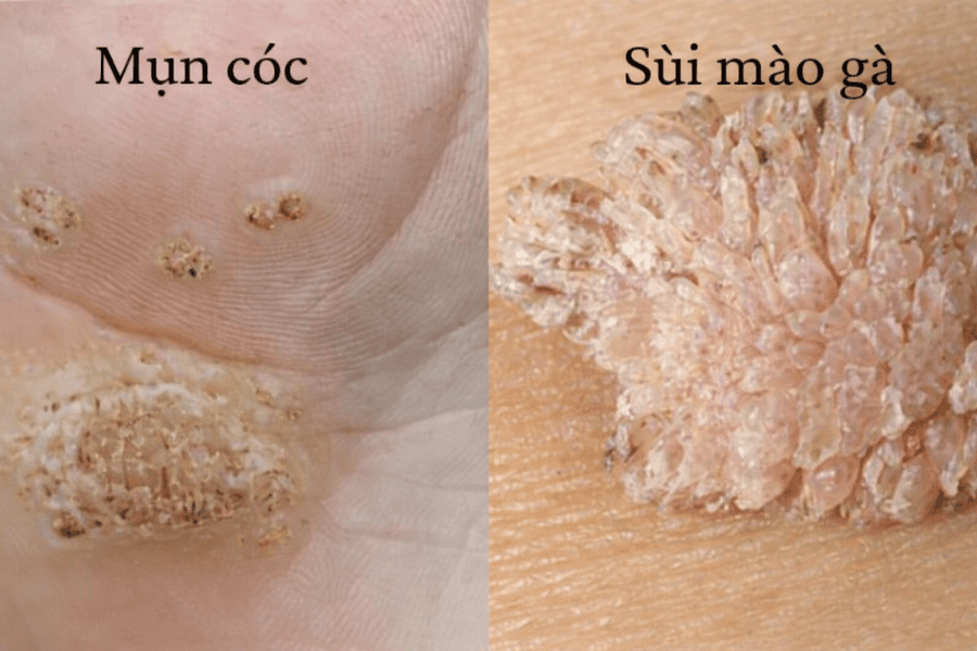 Phân biệt mụn cóc sinh dục và sùi mào gà