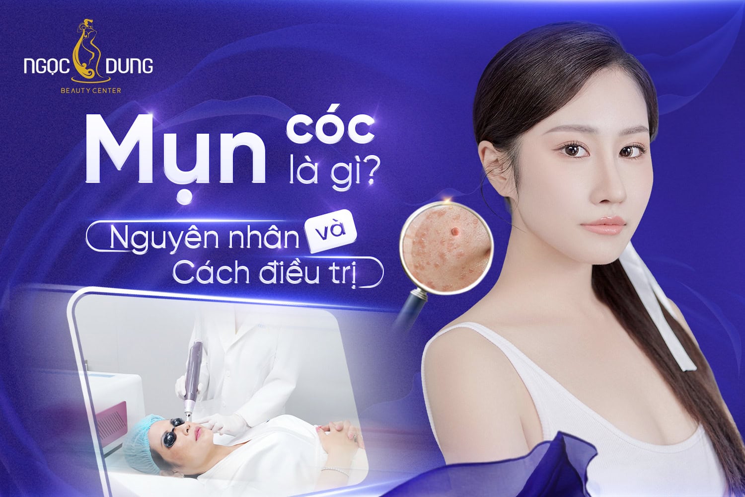 Mụn cóc là gì