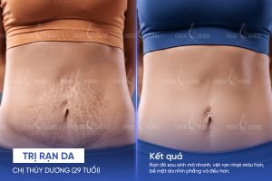 Chị Thùy Dương (29 tuổi) - Trị rạn da