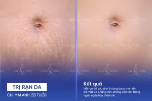 Chị Mai Anh (33 tuổi) - Trị rạn da