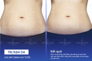 Chị Kim Oanh (40 tuổi) - Trị rạn da