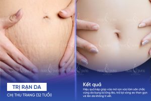 Chị Thu Trang (32 tuổi) - Trị rạn da