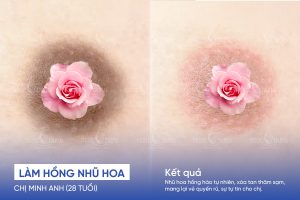 anh truoc sau lam hong nhu hoa 1