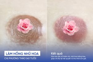 anh truoc sau lam hong nhu hoa 2