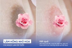 anh truoc sau lam hong nhu hoa 3