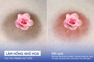 anh truoc sau lam hong nhu hoa 4