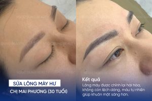 ảnh trước sau sửa lông mày hư 1