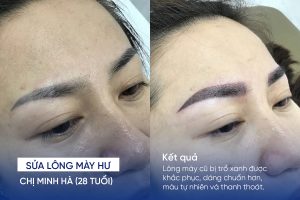ảnh trước sau sửa lông mày hư 2