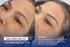 ảnh trước sau sửa lông mày hư 3