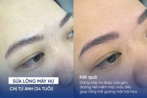 ảnh trước sau sửa lông mày hư 4