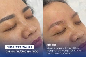 ảnh trước sau sửa lông mày hư 5