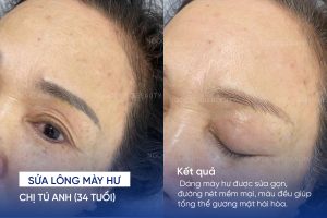 ảnh trước sau sửa lông mày hư 6