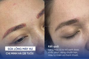 ảnh trước sau sửa lông mày hư 7