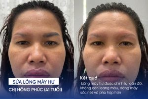 ảnh trước sau sửa lông mày hư 8