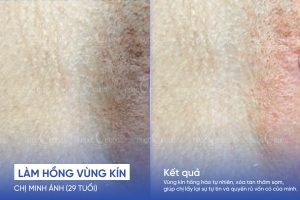 Chị Minh Ánh (29 tuổi) - Trị thâm vùng kín