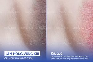 Chị Hồng Hạnh (35 tuổi) - Trị thâm vùng kín