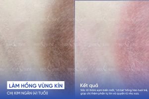 Chị Kim Ngân (41 tuổi) - Trị thâm vùng kín