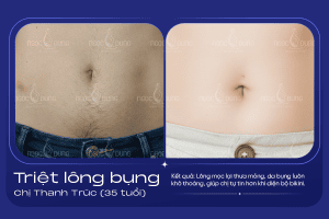 anh truoc sau triet long bung 1
